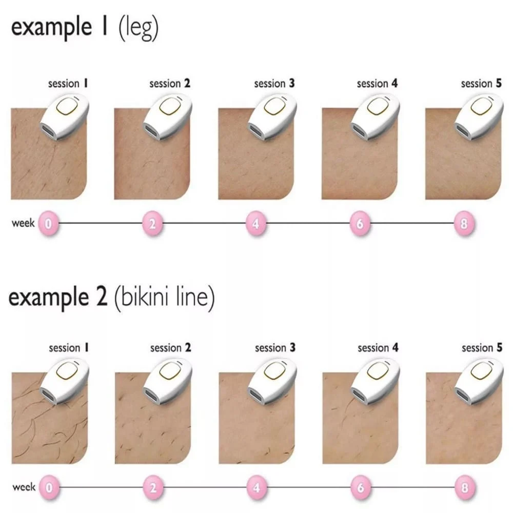 APPLE Home Laser (852-9) - IPL hair removal device with 500,000 flashes — image 4