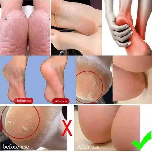 Silicone heel for heel pain treatment — image 2